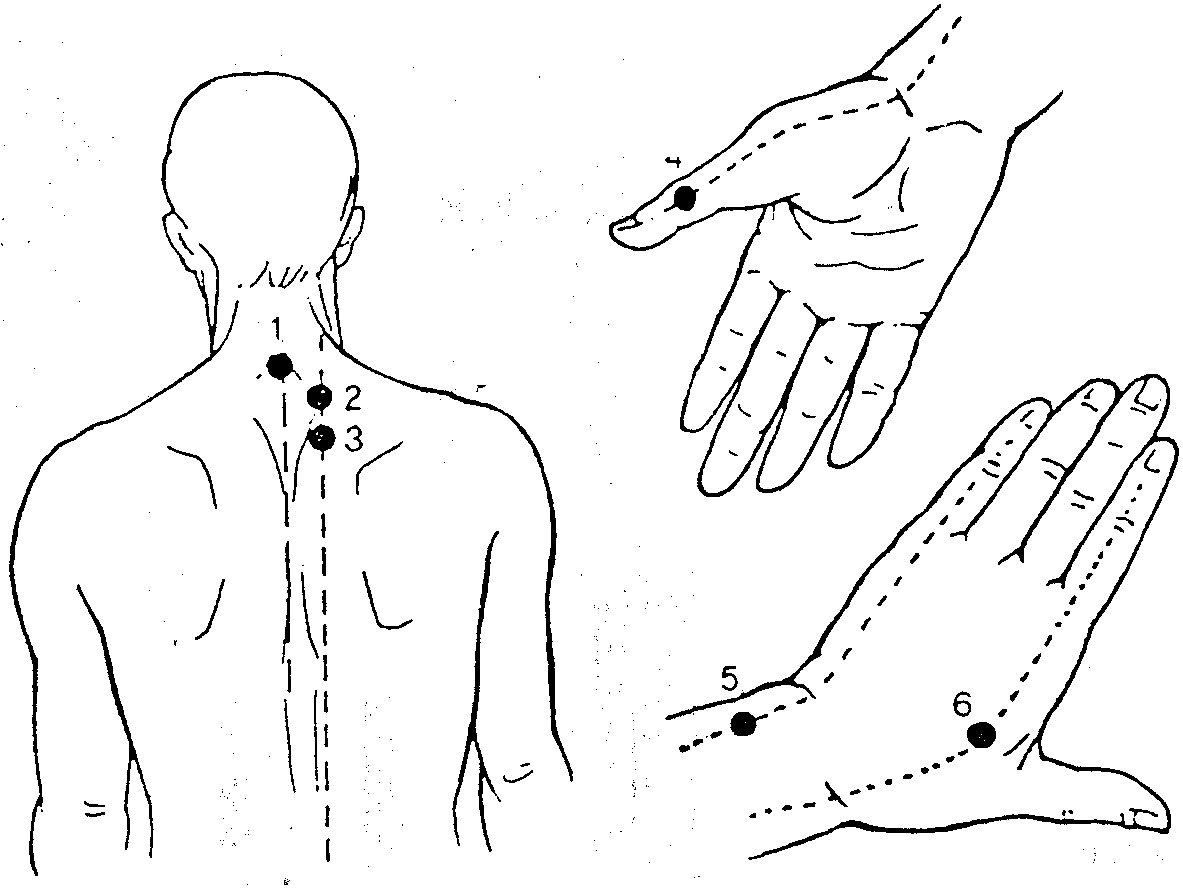 Точка массажа. Акупунктурные точки моксотерапия. Моксотерапия активные точки. Точки для мопскстерапии.